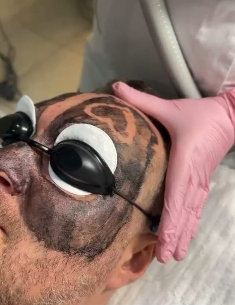 Laserowy peeling węglowy – zdjęcie 1