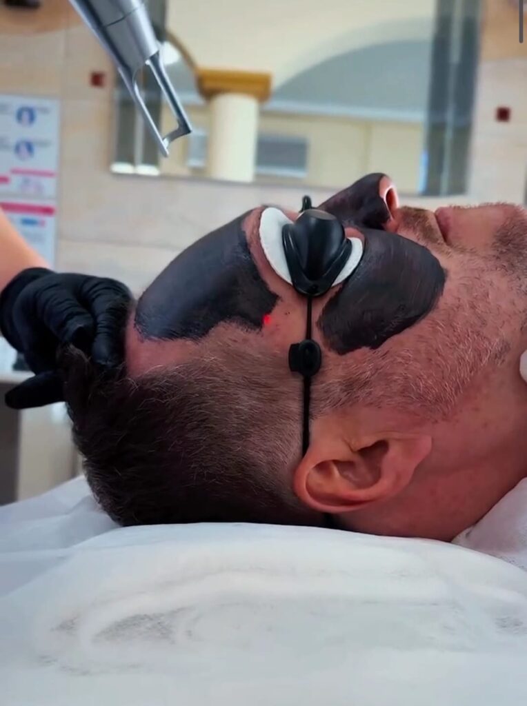 Laserowy peeling węglowy – zdjęcie 2
