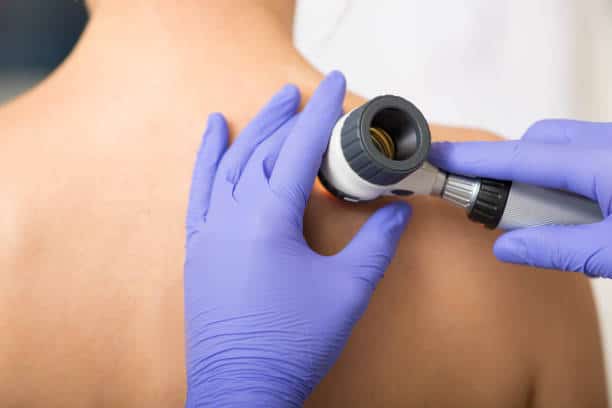 Badanie znamion – dermatoskopia – zdjęcie 1