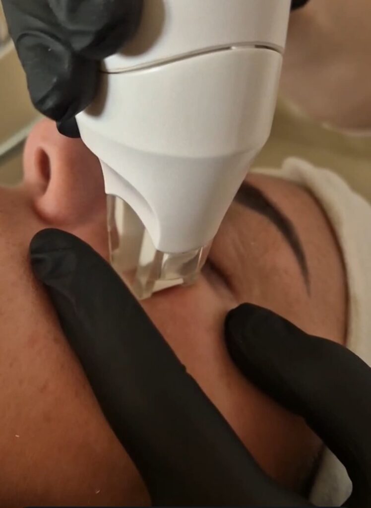 Endermologia twarzy – zdjęcie 2