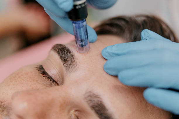 Mezoterapia mikroigłowa Dermapen – zdjęcie 2
