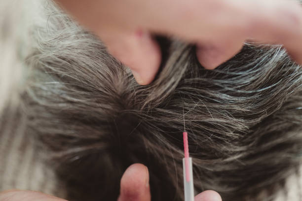 Mezoterapia igłowa Dr Cyj – zdjęcie 2