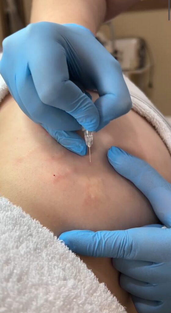 Karboksyterapia – zdjęcie 1