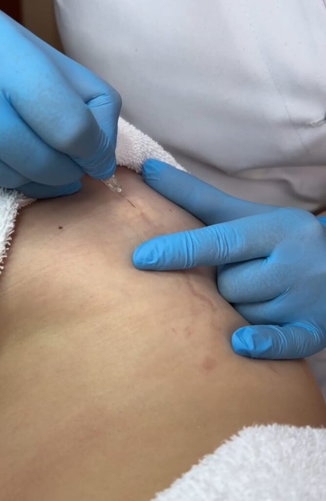 Karboksyterapia – zdjęcie 2