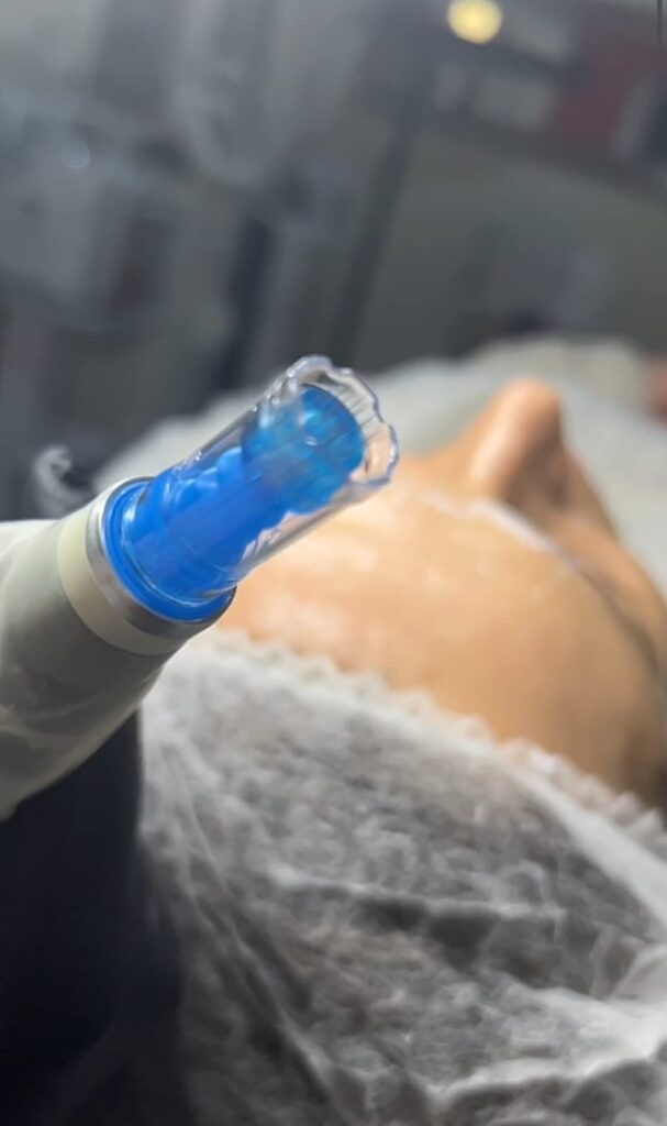 Mezoterapia mikroigłowa Dermapen – zdjęcie 1