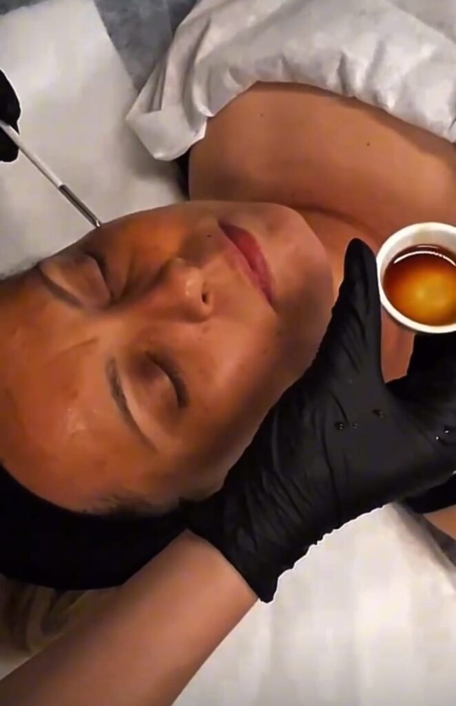Peelingi chemiczne – zdjęcie 2