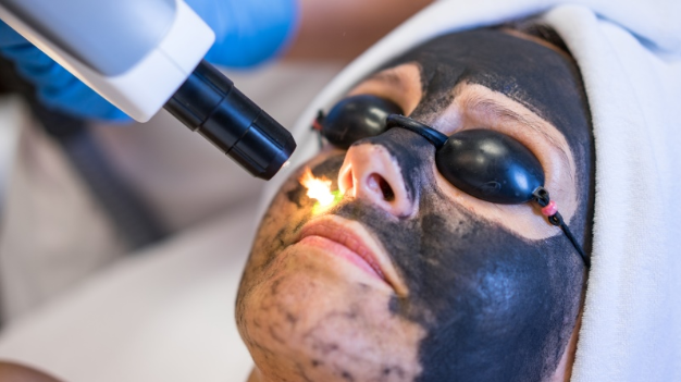Laserowy peeling węglowy – Derkomed Tarnowskie Góry