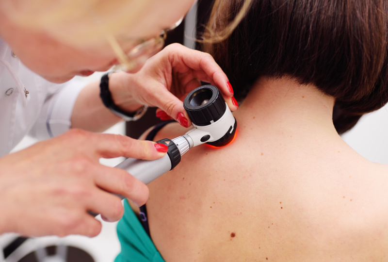 Pieprzyki – zostawić czy usunąć? Kiedy iść do dermatologa